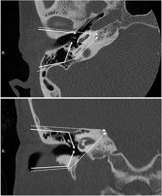 Treatment Outcome of External Auditory Canal Carcinoma: The Utility of Lateral Temporal Bone Resection